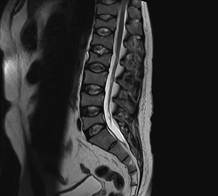 Resonancia magn�tica sagital en T2 de columna dorso-lumbar, configurando el signo de v�rtebra de pescado. Los cuerpos vertebrales muestran deformaci�n bic�ncava en paciente var�n de 34 a�os con diagn�stico de p�rpura trombocitop�nica idiop�tica y osteoporosis inducida por corticosteroides (archivo original del Centro Radiol�gico DMI, Chiclayo, Per�).