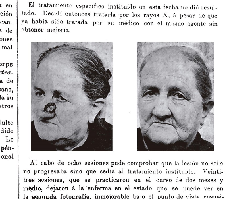   Un caso de epitelioma curado por rayos X (
              Lanari, 1903)
            