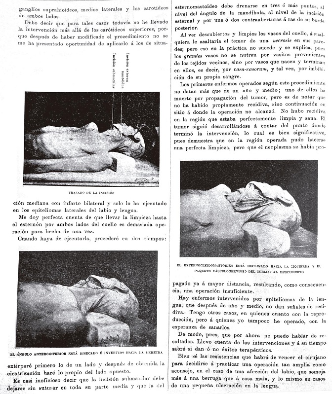 Proceder operatorio en los epiteliomas del labio y de la lengua (Gutiérrez, 1904a)