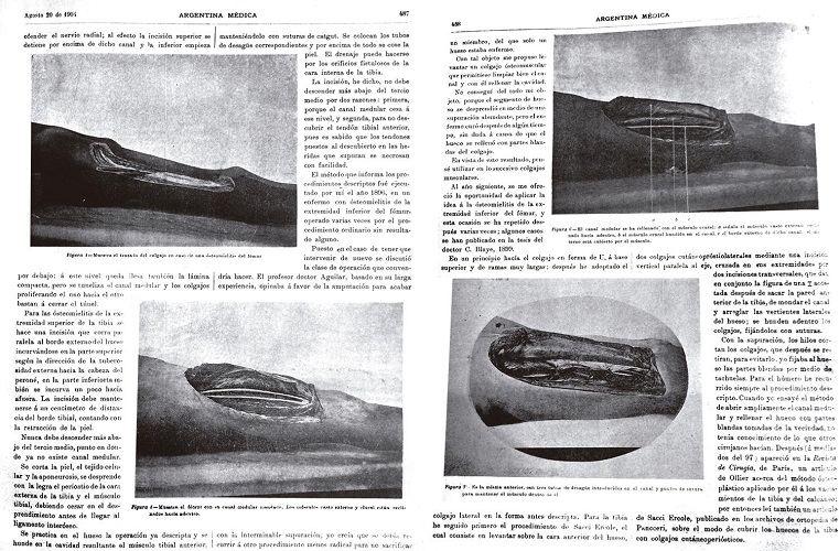 Tratamiento de las ostiomelitis crónicas prolongadas (Gutiérrez, 1904b)