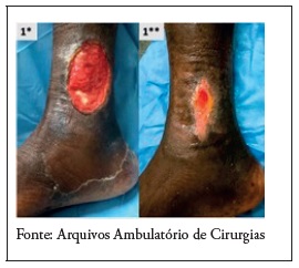 Ferida do participante 1: no 1 dia (1*) e final do seguimento (1**) de 13 semanas