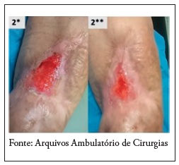 Ferida do participante 2: no 1 dia (2*) e 8 semana de seguimento (2**)