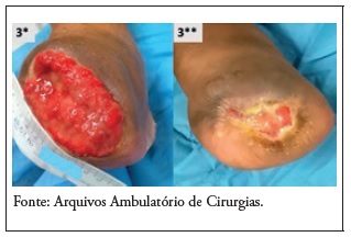 Ferida do participante 3: no 1 dia (3*) e final do seguimento (3**) de 15 semanas