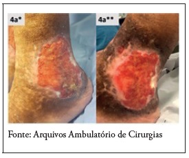 Ferida do malolo lateral do participante 4: no 1 dia (4a*) e final do seguimento (4a**) de 13 semanas