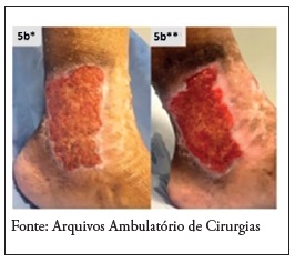 Ferida do malolo medial do participante 4: no 1 dia (5b*) final do seguimento (5b**) de 13 semanas