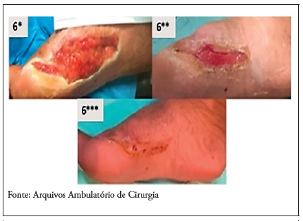 Ferida do participante 5: sete dias antes do incio (6*), na 4 semana (6**) e ao final do seguimento (6***) de 8 semanas 