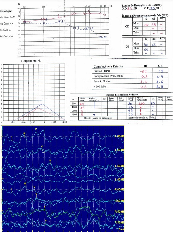 Audiometria, logoaudiometria, imitanciometria e PEATE do caso 1