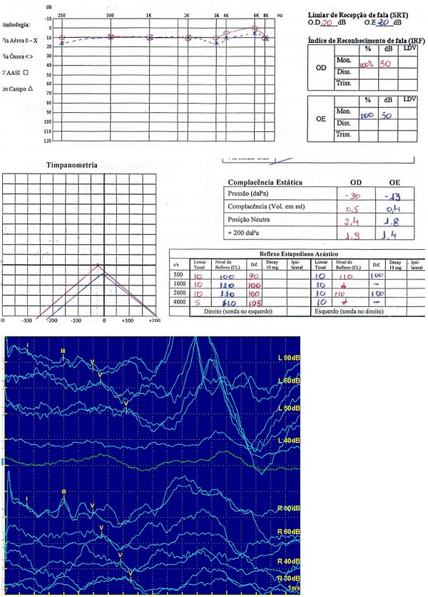 Audiometria, logoaudiometria, imitanciometria e PEATE do caso 2