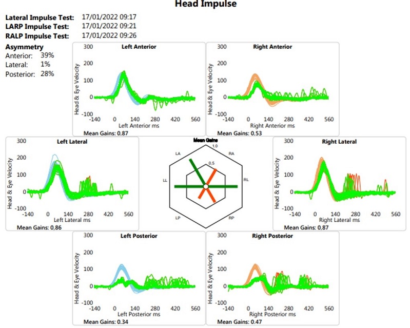 Ganho dos canais semicirculares antes da reabilita&ccedil;&atilde;o vestibular (devido ao software utilizado s&oacute; &eacute; poss&iacute;vel a apresenta&ccedil;&atilde;o da figura em l&iacute;ngua inglesa)