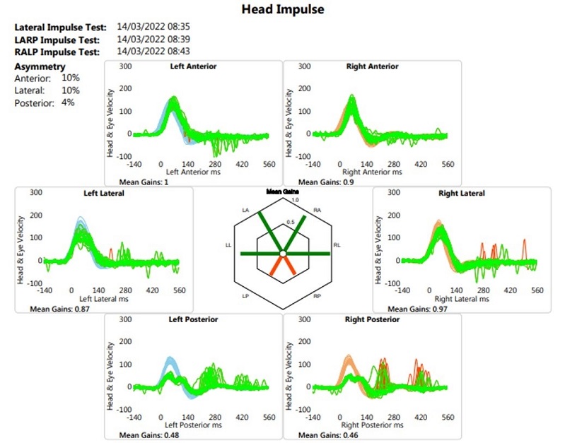 Ganho dos canais semicirculares ap&oacute;s a reabilita&ccedil;&atilde;o vestibular (devido ao software utilizado s&oacute; &eacute; poss&iacute;vel a apresenta&ccedil;&atilde;o da figura em l&iacute;ngua inglesa)