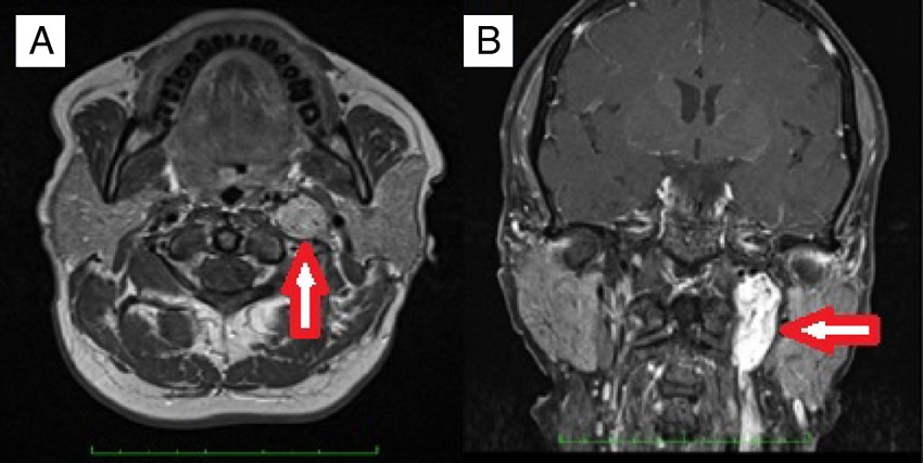 A case of left sided TJP with typical salt and pepper appearance; meaning areas
of high and low intensity on MRI. (A) An axial section of T1 weighted sequences. (B)
A coronal section of T1 weighted fat suppressed sequences.