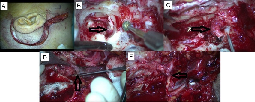 A case of TJP presented with HB grade 5 facial nerve palsy and undergone gross
total tumor excision via IFTA-A approach after preoperative embolization. (A)
Post-auricular incision with cervical extension. (B) Tumor extension is seen in
hypotympanium during mastoidectomy. (C) Facial nerve is sacrificed which is invaded
by tumor at stylomastoid foramen region. (D) Tumor originating from jugular bulbus.
(E) CN 7-12 anastomosis.