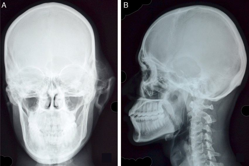 (A) Skull PA view reveals swelling of osseus origin overlying left temporal bone
with thinned out cortex and interlacing septae. There is associated breach in the
cortex of left greater wing of sphenoid and non-visualization of left petrous bone.
Soft tissue swelling and lateral displacement of left pinna is seen. (B) Lytic,
geographic lesion in left temporal bone with, narrow zone of transition and irregular,
sclerotic margins is well appreciated on the lateral view.