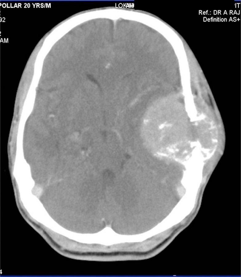 On soft tissue window settings, the lesion shows enhancing soft tissue with a
large intracranial component causing mass effect and mild white matter edema in the
adjacent temporal lobe and a small superficial component in the scalp. A few small
specks of matrix mineralization are noted as well.