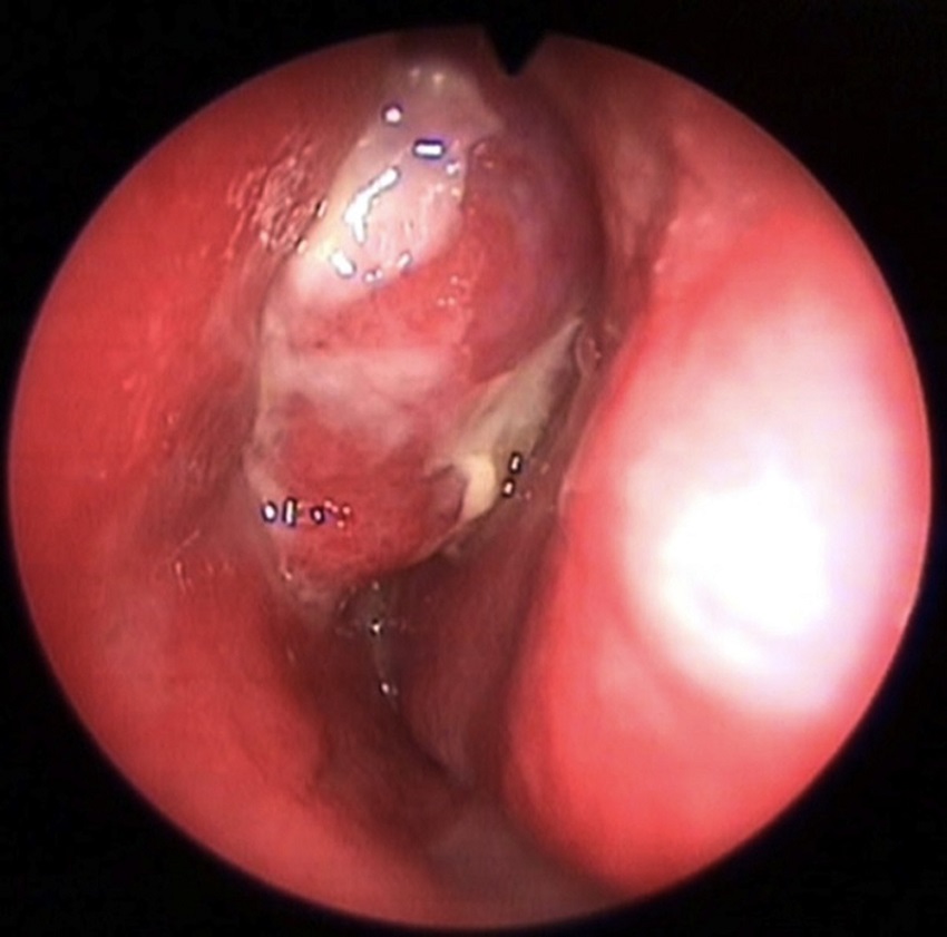 Reddish-gray-colored polypoid mass in the left nasal passage.