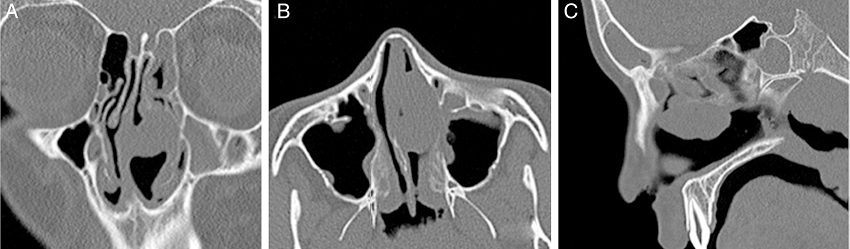 Intensely enhanced homogenous mass lesion originating from the left middle
              turbinate on coronal (A), axial (B), and sagittal (C) computed tomography
              images.