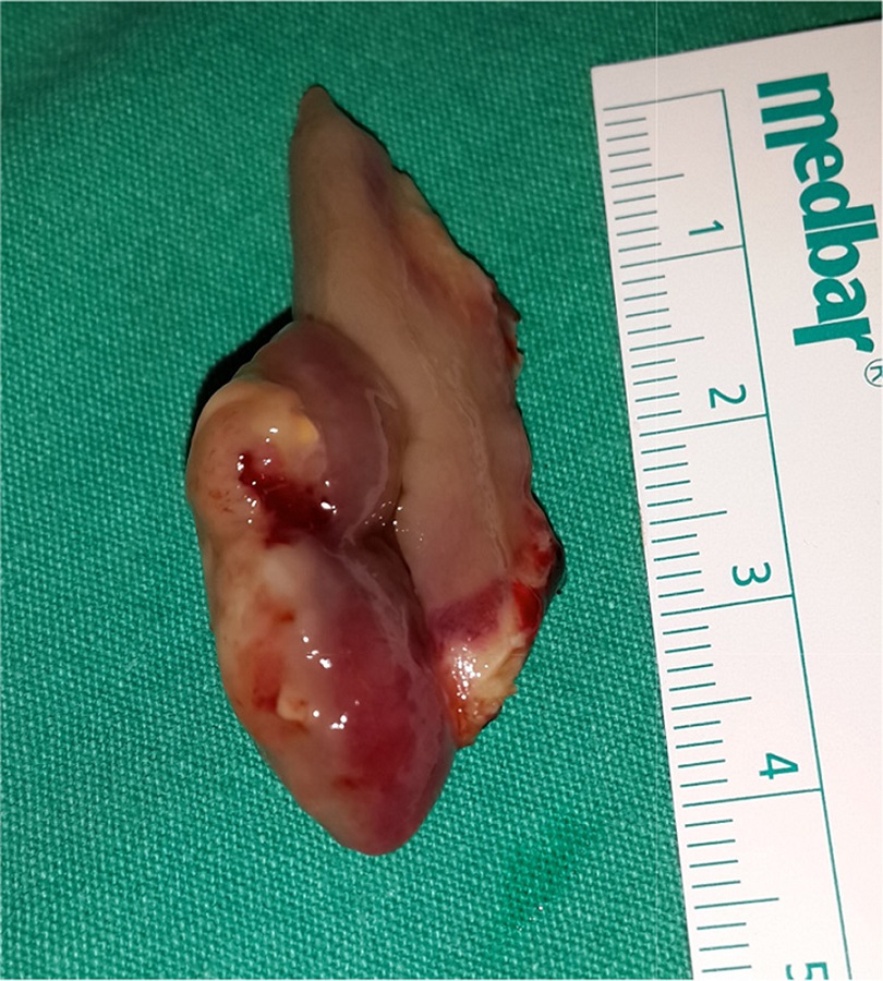 Excised mass; lobular, red-grayish, about 30 mm long and 10 mm diameter.