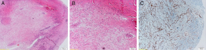 (A-C) Microscopic findings of the specimen showed that many irregular vascular
              structures range from capillaries and sinusoids surrounded by a fibrous
              stroma.