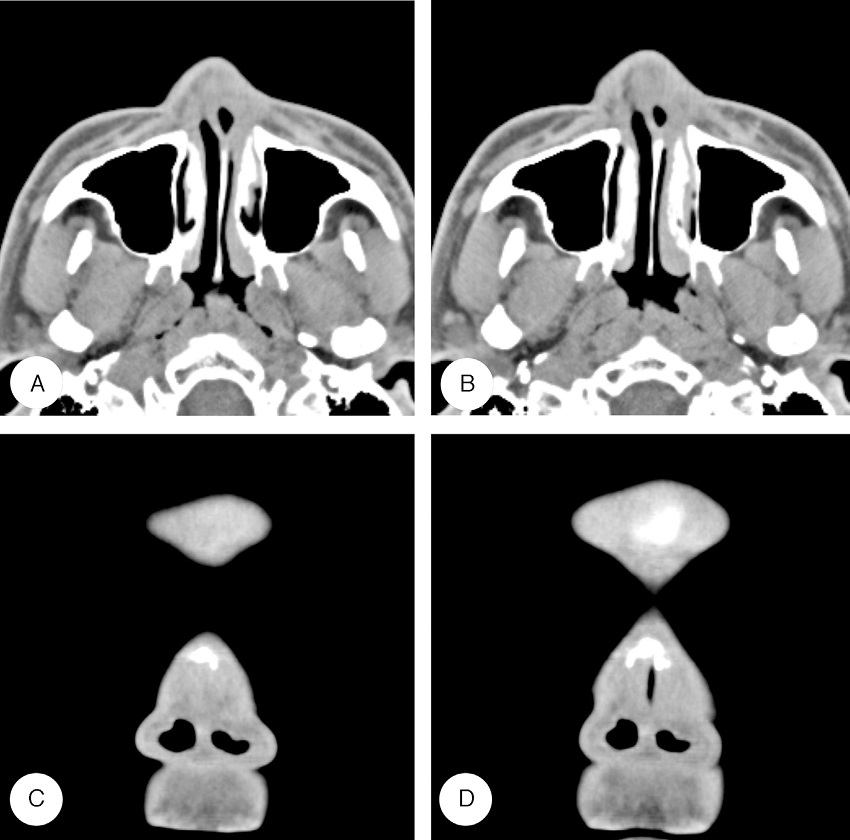 Iatrogenic nasal vestibular stenosis after maxillofacial reconstructive