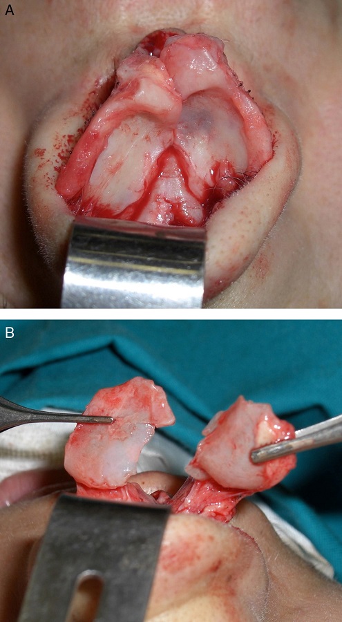 (A) Alar cartilage exposition after the open technique was performed. (B)
                Bilateral cut of the posterior cartilage portion.
