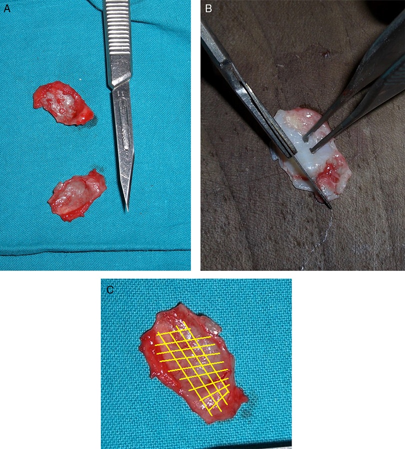 (A) Images of cartilages detached from the original point. (B) Remodeling of
                the cartilage to achieve the correct anatomy. (C) Fragilizing lines scheme.