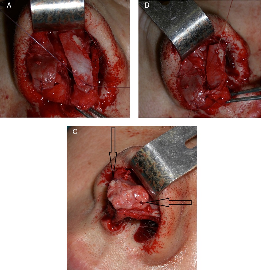 (A) Suture of the anterior portion of the alar cartilage. (B) Suture of the
                posterior portion of the alar cartilage. (C) Apposition of the columella graft to
                define the point, the arrows show in detail the sutures positions.
