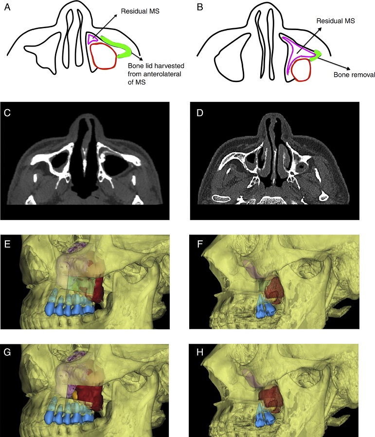 Diagram of surgical approach. A, C, E and G, For a large lesion,
                  anterolateral bony wall of maxillary needs to be removed to distinguish boundary
                  of sinus mucosa and cyst wall, and to remove the lesion; B, D, F and H, For a
                  relatively small lesion, only a small amount of bone posterior to
                  zygomaticoalveolar crest removal is enough (the red area shows the cyst, purple
                  area shows affected sinus, orange area shows tooth in the cyst, green area shows
                  the bone plate removal, and blue area shows maxillary teeth of the affected side).
                  MS, maxillary sinus.