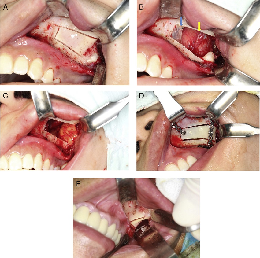 Surgical approach. (A) Bony wall reimplantation method: use piezosurgery to
                  make a window anterolateral wall of the maxillary sinus, and cut medial, upper and
                  lower osteotomy line first. (B) Lesion exposure after bone removal (the blue arrow
                  shows sinus mucosa, and yellow arrow shows cyst wall). (C) Fill pedicled buccal
                  fat pad flap into bone cavity. (D) Bone plate was repositioned and fixed by mini
                  titanium plates. (E) Bone removal method: make a window lateral to
                  zygomaticoalveolar crest.