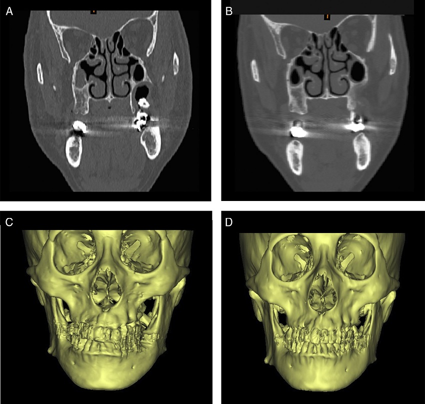 CT and 3D reconstruction images of bone removal method. (A and C) Before
              operation. (B and D) Images postoperatively shows normal shape.