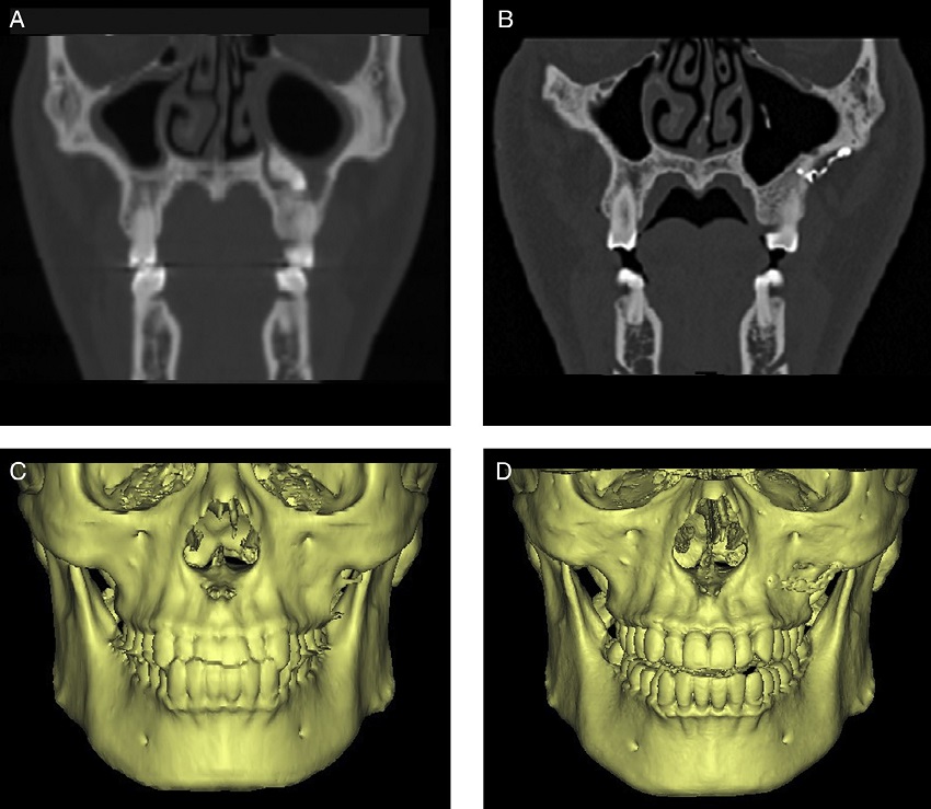 CT and 3D reconstruction images of bony wall reimplantation method. (A and C)
              Before operation. (B and D) Images post-operatively showing normal shape and no bone
              resorption.