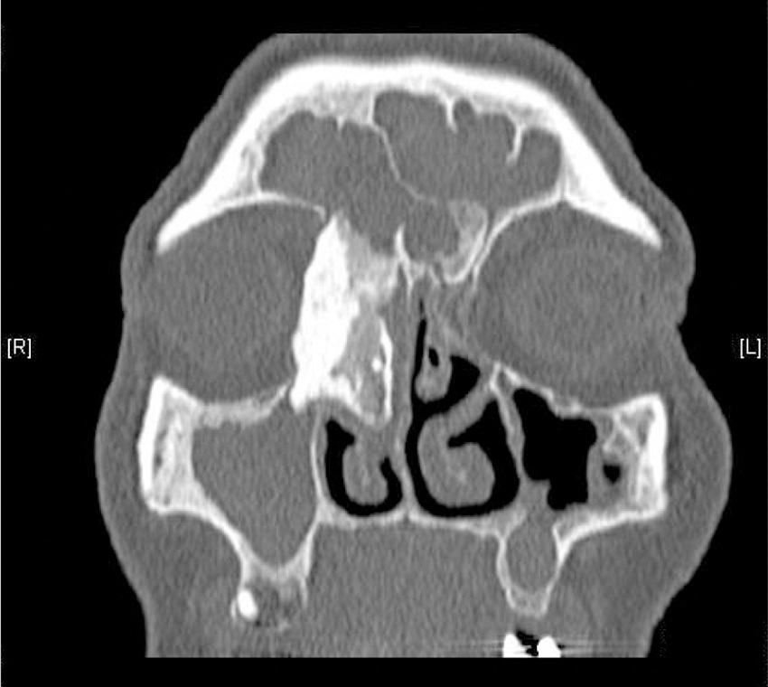 CT scan of the sinuses - fronto-ethmoidal osteoma sized about 39.5 &times; 19.8
              &times; 19.4 mm, coronal plane.