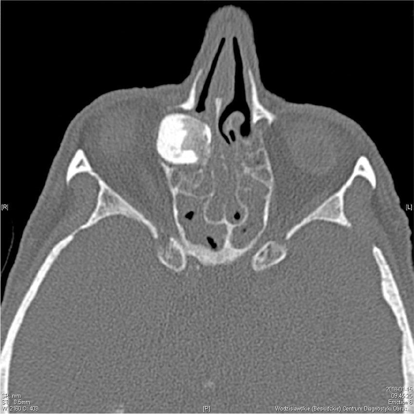 CT scan of the sinuses - fronto-ethmoidal osteoma, axial plane.