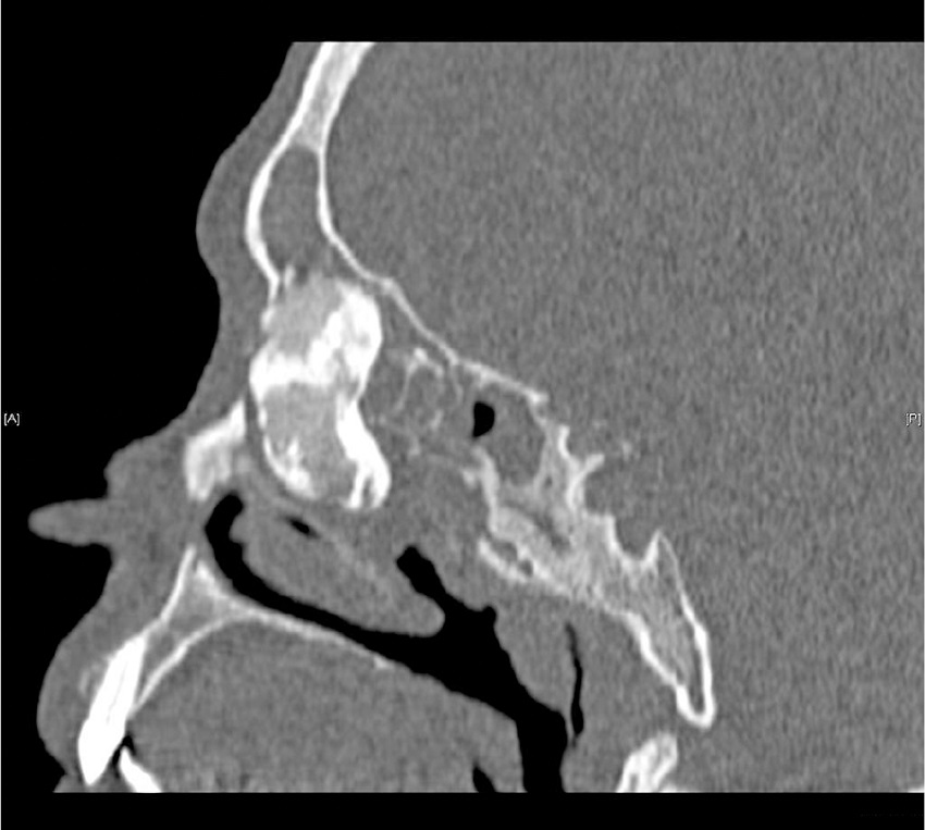 CT scan of the sinuses - giant fronto-ethmoidal osteoma, sagittal plane.