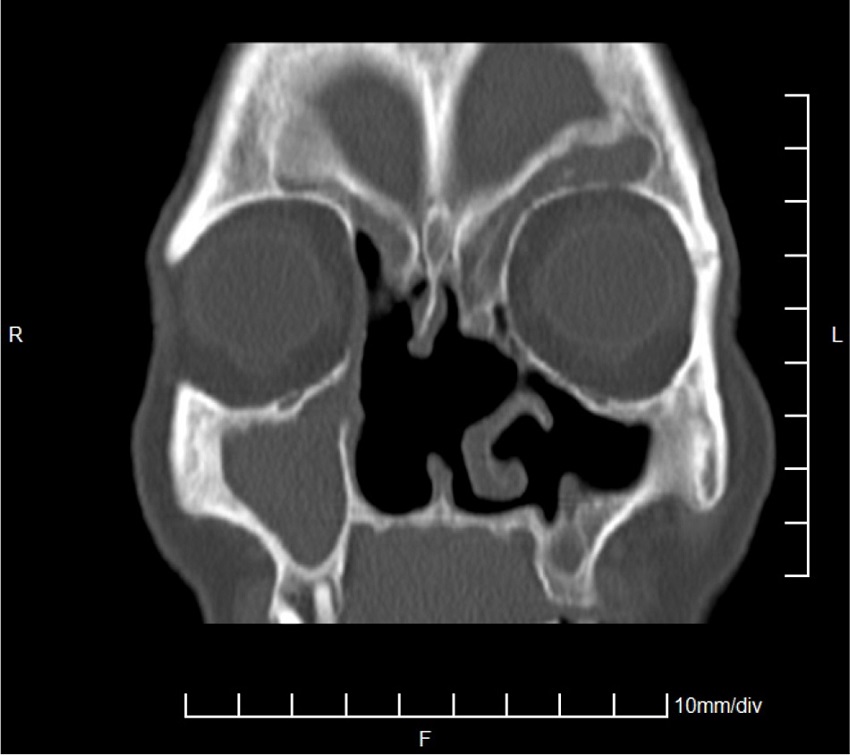 CT scan of the sinuses - 12 months after surgery, coronal plane.
