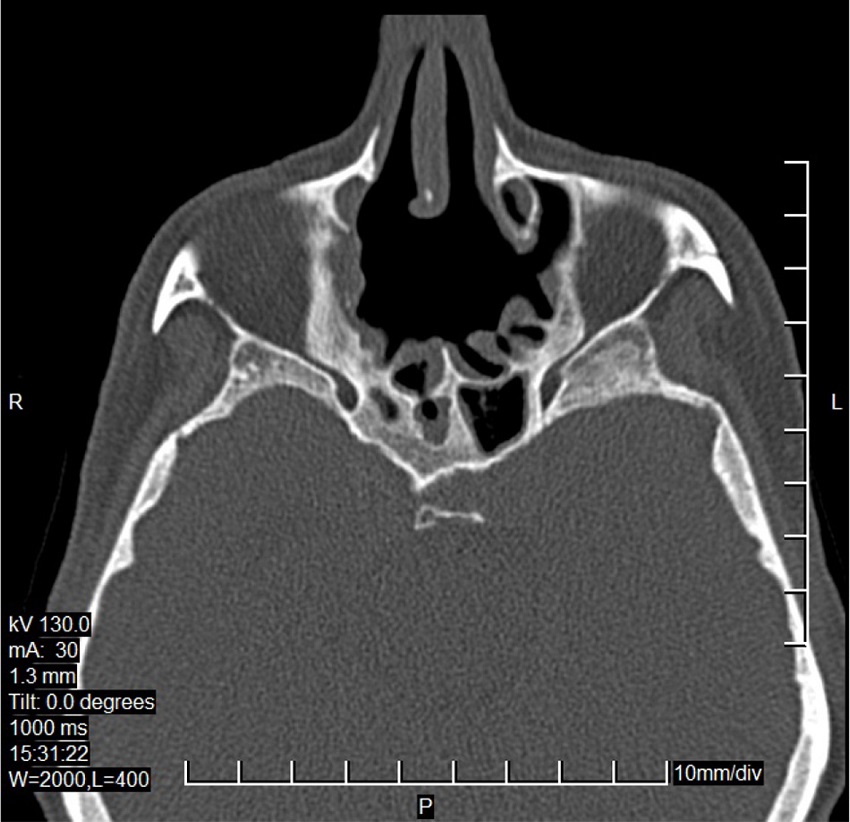 CT scan of the sinuses - 12 months after surgery, axial plane.