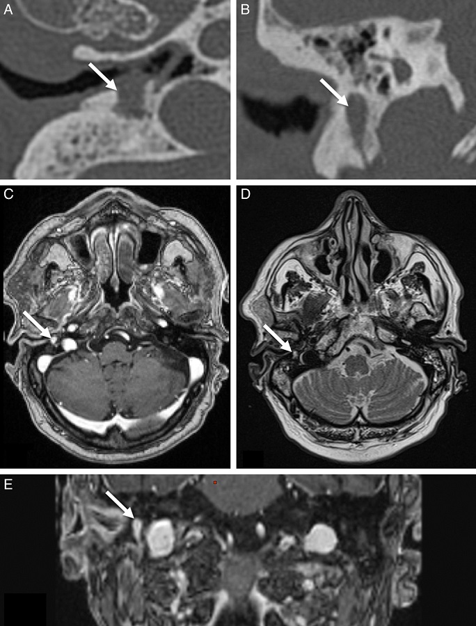 Radiological examination of chorda tympani schwannoma with associated MOE. (A)
              Axial CT scan demonstrating well-defined soft tissue lesion. (B) Reconstructed coronal
              CT image demonstrating above soft tissue lesion caused an osteolytic erosion of the
              mastoid along the vertical segment of the facial nerve. (C) T1 with gadolinium MRI
              image in axial projection: the chorda tympani tumor exhibits a homogenous
              hyper-enhancement. (D) The MRI axial T2-weighed image in axial projection shows the
              hyperintense schwannoma. (E) T1 with gadolinium MRI image in coronal projection: the
              chorda tympani tumor exhibits a homogenous hyper-enhancement. MOE, malignant otitis
              externa; CT, computed tomography; MRI, magnetic resonance imaging.