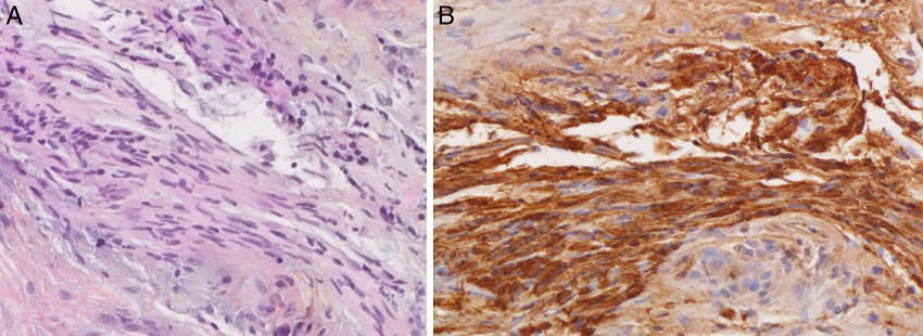 Histological examination of chorda tympani schwannoma with inflammatory tissue by
              associated MOE (200&times;). (A) Histological examination shows typical elongated
              spindle cells that tend to form palisades on hematoxylin-eosin safran) (HES)
              coloration. (B) Spindle cells are diffusely and strongly positive for S100 protein.
              MOE, malignant otitis externa.