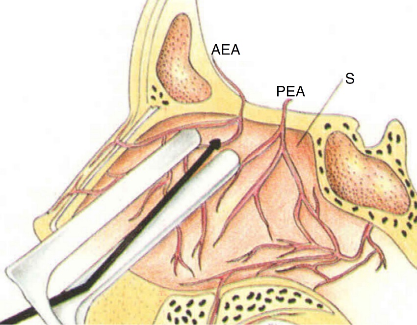 Cauteriza&ccedil;&atilde;o microsc&oacute;pica dos ramos da art&eacute;ria etmoidal anterior
                            (AEA, art&eacute;ria etmoidal anterior; PEA, art&eacute;ria etmoidal posterior; S,
                            septo).