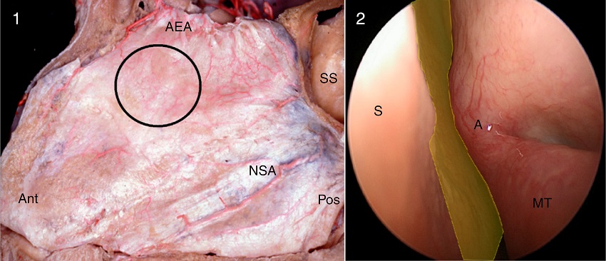 Fossa nasal esquerda, dissec&ccedil;&atilde;o anat&ocirc;mica (1) e vis&atilde;o endosc&oacute;pica
                                (2). O c&iacute;rculo preto e a &aacute;rea amarela mostram a regi&atilde;o onde o
                                S-point (um ramo da art&eacute;ria etmoidal anterior) pode ser encontrado,
                                superior ao meato m&eacute;dio, em uma regi&atilde;o que normalmente n&atilde;o &eacute;
                                examinada nas cirurgias endosc&oacute;picas nasais (Ant, anterior; Pos,
                                posterior; AEA, art&eacute;ria etmoidal anterior; NSA, art&eacute;ria nasosseptal;
                                SS, seio esfenoidal; S, septo nasal; A, axila da concha m&eacute;dia; MT,
                                concha m&eacute;dia).