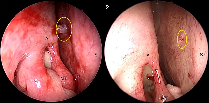 Fossa nasal direita. S-point (c&iacute;rculo amarelo) antes (1) e ap&oacute;s
                                (2) o uso de algod&atilde;o com descongestionante t&oacute;pico. Ap&oacute;s
                                vasoconstritor, o ped&iacute;culo vascular S- point praticamente
                                desaparece. (A, axila da concha m&eacute;dia; MT, concha m&eacute;dia; S, septo
                                nasal).