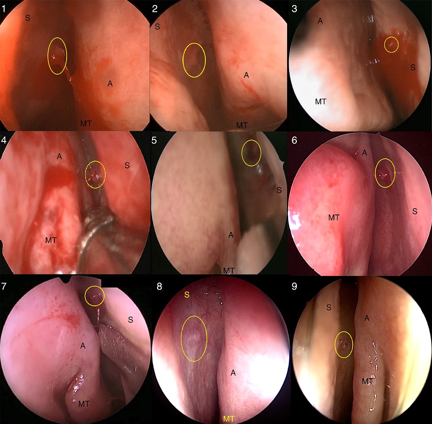Identifica&ccedil;&atilde;o do S-point em nove casos (1 a 9). O S-point foi
                                marcado com o c&iacute;rculo amarelo (S, septo nasal; A, axila da concha
                                m&eacute;dia; MT, concha m&eacute;dia).