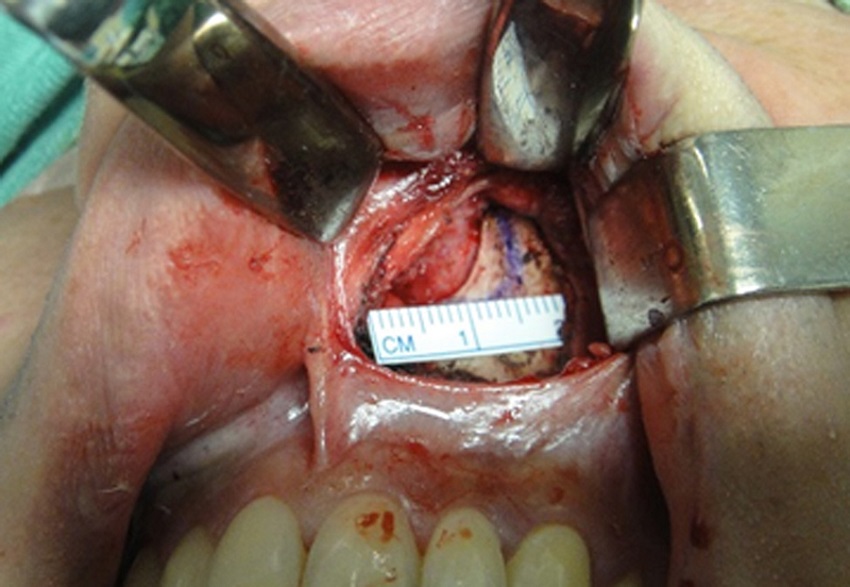 Marking the bone portion to be removed.