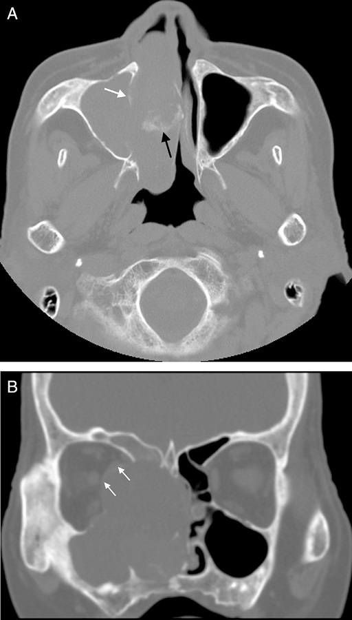 (A) Axial CT scan shows the soft tissue mass in the paranasal sinus and nasal
              cavity. Bone destruction of the medial wall of maxillary sinus is apparent and the
              margin is obscure (white arrow in A). Patchy calcification is found in the lesion
              (black arrow in A). (B) Coronal CT scan shows main body of soft-tissue mass is located
              in ethmoid sinus and nasal cavity and it damaged bone of right orbit with compression
              of the medial rectus (white arrow in B). The wall of the right ethmoidal sinus, right
              maxillary sinus and right frontal sinus were damaged.