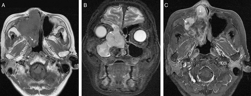 (A) Axial T1-weighted image shows lower-signal intensity and high-signal
              intensity. The surrounding structures are compressed. Hemorrhagic focus can be found
              in the mass (white arrow in A). (B) Coronal T2WI with fat suppression shows the lesion
              more obviously. The lesion involved the right ethmoidal sinus, right maxillary sinus,
              right frontal sinus and right nasal cavity. Medial rectus was compressed to the right
              side by the lesion (white arrow in B). (C) Contrast-enhanced T2-weighted image with
              fat-suppression shows heterogeneous enhancement of the soft tissue mass and striped
              dis-enhanced region (white arrow in C).