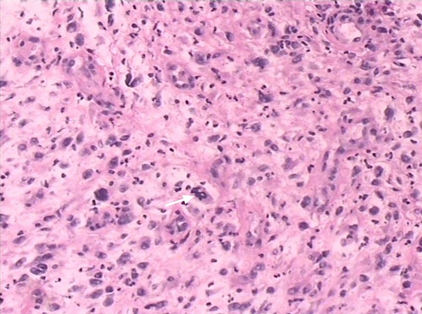 Pathological analysis of UHPS showed that spindle cell bestrewed in the horizon
              (hematoxylin-eosin staining, original magnification: 10&times; objective lenses).
              Multinuclear giant cell can be founded in the background of spindle cell (white
              arrow).