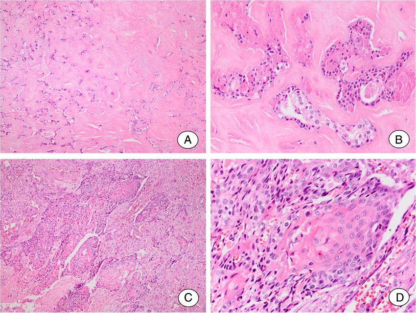 Squamous cell carcinoma ex pleomorphic adenoma. (A, B) Residual
                                pleomorphic adenoma. (A) Pleomorphic adenoma area shows extensive
                                hyalinization of the stroma. (B) Few ductal structures lined by
                                cells without atypical features can be seen. (C, D) Carcinomatous
                                component. (C) A frankly invasive squamous cell carcinoma is the
                                malignant component of the tumor. (D) Detail of the malignant
                                component showing islands formed by cells with squamous
                                differentiation.