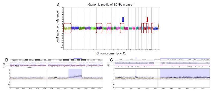 Copy number alterations detected by array comparative genomic
                                hybridization (CGH) in the squamous cell carcinoma ex pleomorphic
                                adenoma case. (A) Array-CGH genomic profile exhibiting the all the
                                identified copy number alterations of this case. The
                                    x-axis represents probes ordered according to
                                their genomic position from chromosomes 1p to Xq (each chromosome is
                                labeled with a different color). The y-axis denotes
                                the log2 test/reference values (genomic gains and losses
                                are plotted above or below the 0 baseline, respectively; images
                                adapted from the software Nexus Copy Number 7.0, Biodiscovery). The
                                red box indicates chromosomes that harbor genomic rearrangements of
                                losses or gains: 1, 6, 8, 11, 17, 18, 19 and 22. The arrows show the
                                regions of genomic amplifications at chromosomes 11 and 19. (B)
                                Array-CGH profile of the chromosome 11 showing in detail the two
                                regions with high copy number gain (amplifications): at 11q14q22.1
                                (7 Mb) and at 11q22.1-q22.3 (4.6 Mb) (blue arrow in A). (C)
                                Array-CGH profile of the chromosome 19 exhibiting one region of
                                genomic amplification at 19p13.2 (0.4 Mb) (red arrow in A).