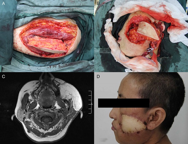 (A) The ALT flap was harvested from the left thigh; (B) the
                                    through-and-through defect over left cheek after excision of
                                    buccal squamous cell carcinoma; (C) postoperative axial MRI
                                    showing the ALT flap; (D) postoperative result 4 months after
                                    operation.