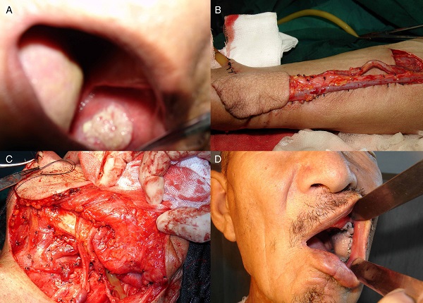 (A) Preoperative view of the buccal mucosa area; (B) the RF
                                    flap was harvested as the graft; (C) the flap was inset and
                                    anastomosed to the vessels; (D) postoperative result 1 month
                                    after operation.