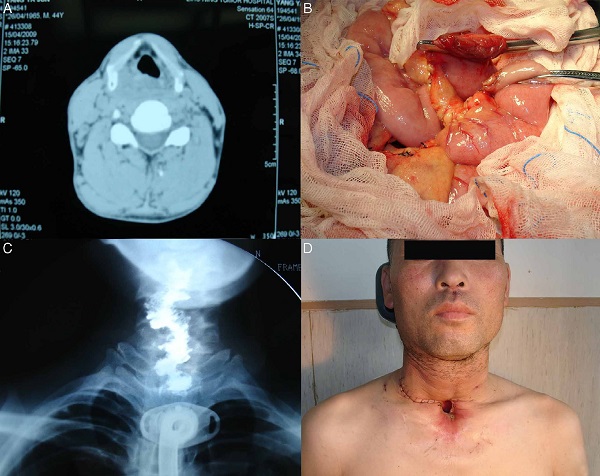 (A) Preoperative view of the hypopharyngeal cancer by CT; (B)
                                    the free jejunum flap was harvested from the left forearm; (C)
                                    barium swallow examination showing the postoperative result; (D)
                                    postoperative result 2 months after operation.